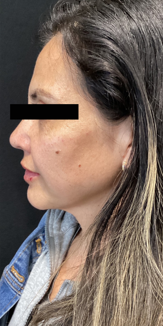 After Image: Cheek Filler - left-side