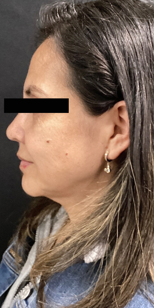 Before Image: Cheek Filler - left-side