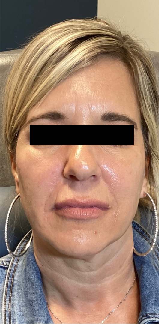 After Image: Cheeks, Lip, Nasiolabial Fold Filler - front