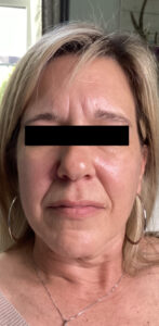 Before Image: Cheeks, Lip, Nasiolabial Fold Filler