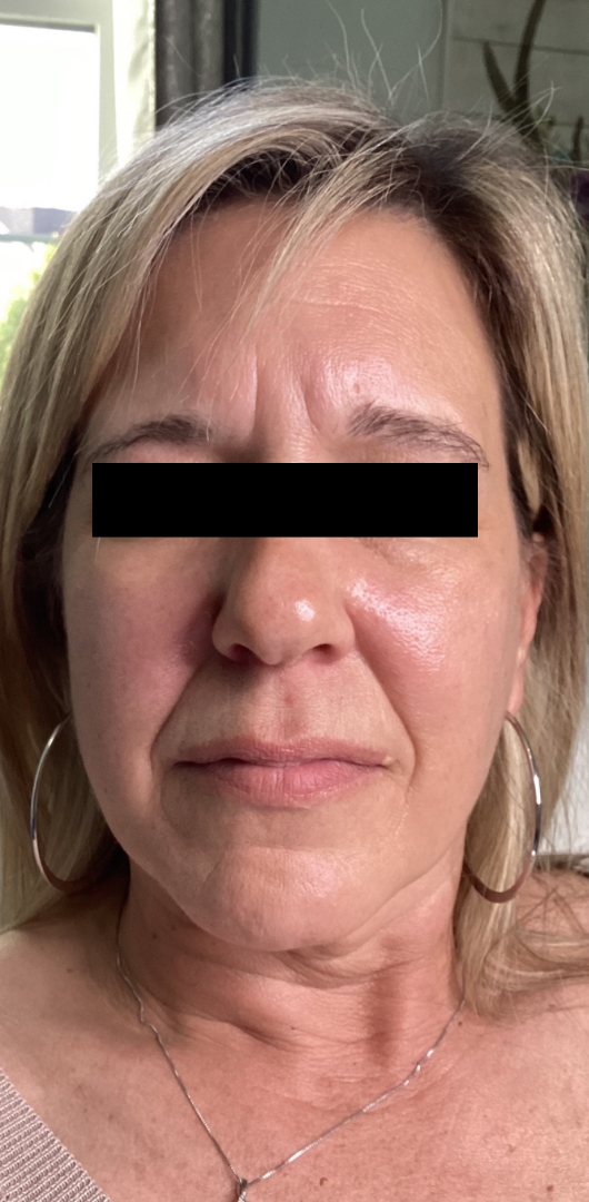 Before Image: Cheeks, Lip, Nasiolabial Fold Filler - front