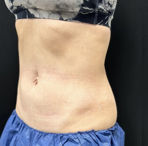 After Image: CoolSculpting - left-front-oblique