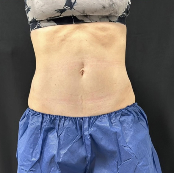 After Image: CoolSculpting - front