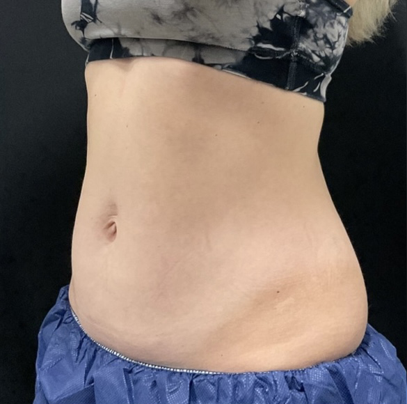 Before Image: CoolSculpting - left-front-oblique