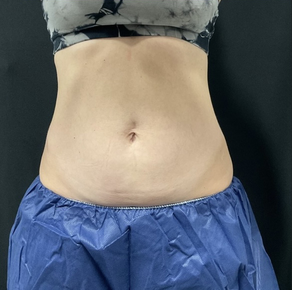 Before Image: CoolSculpting - front