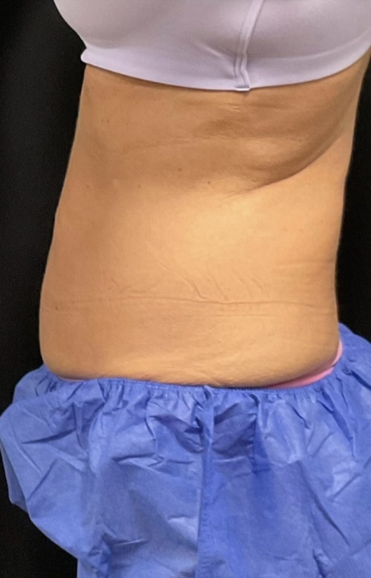 After Image: CoolSculpting - left-side