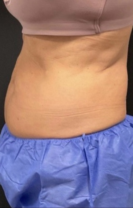Before Image: CoolSculpting - left-side