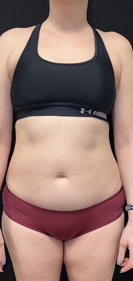 After Image: CoolSculpting - front