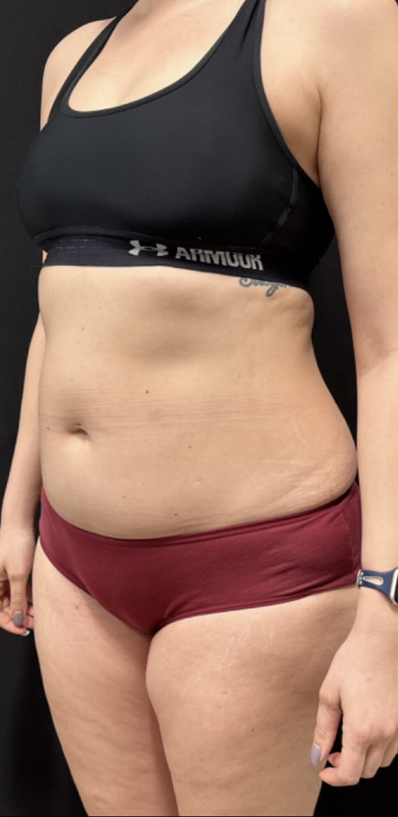After Image: CoolSculpting - left-front-oblique