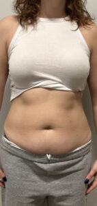 Before Image: CoolSculpting