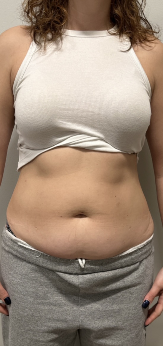 Before Image: CoolSculpting - front