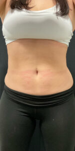 After Image: CoolSculpting