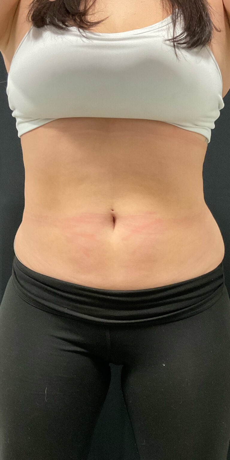 After Image: CoolSculpting - front