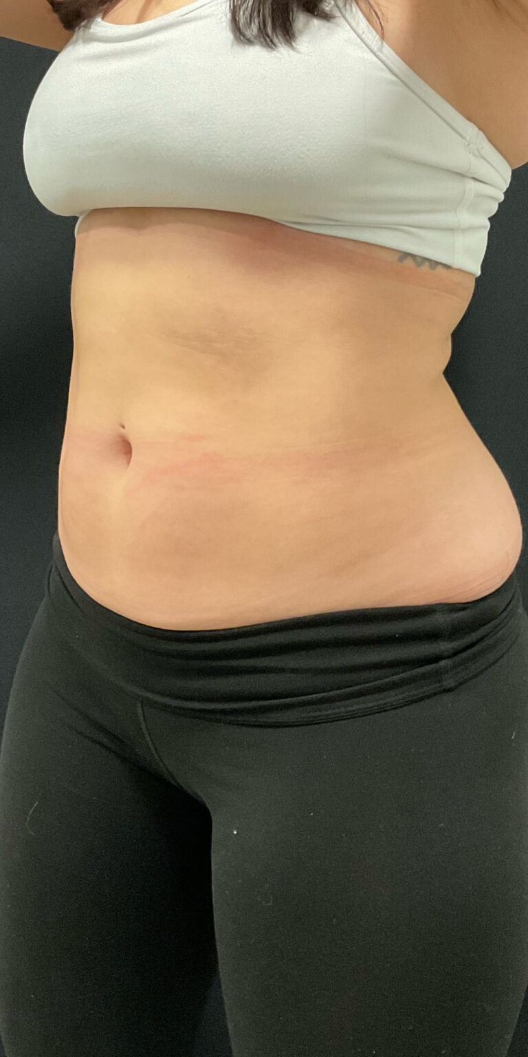 After Image: CoolSculpting - left-front-oblique