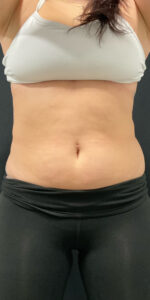 Before Image: CoolSculpting