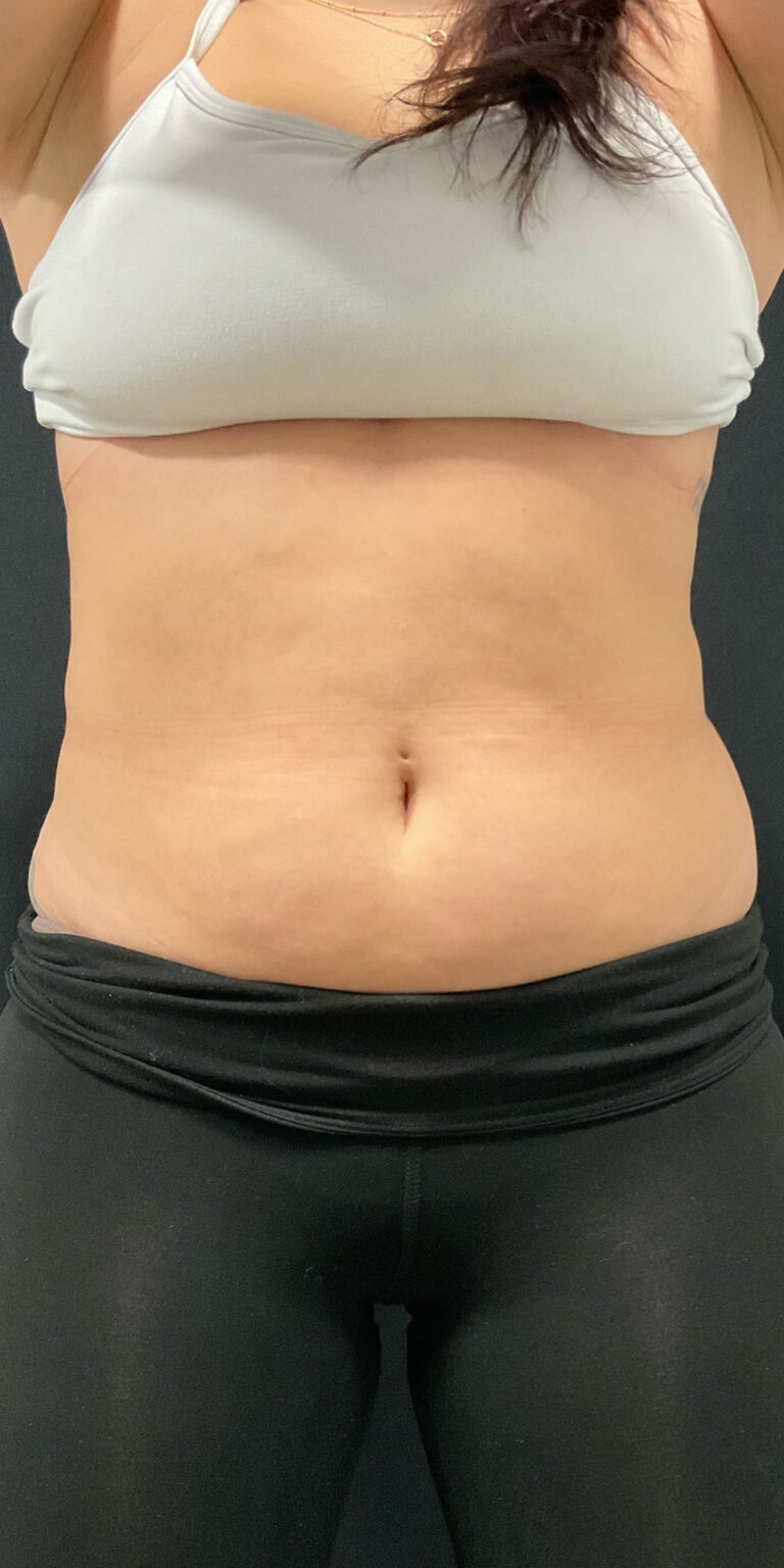Before Image: CoolSculpting - front