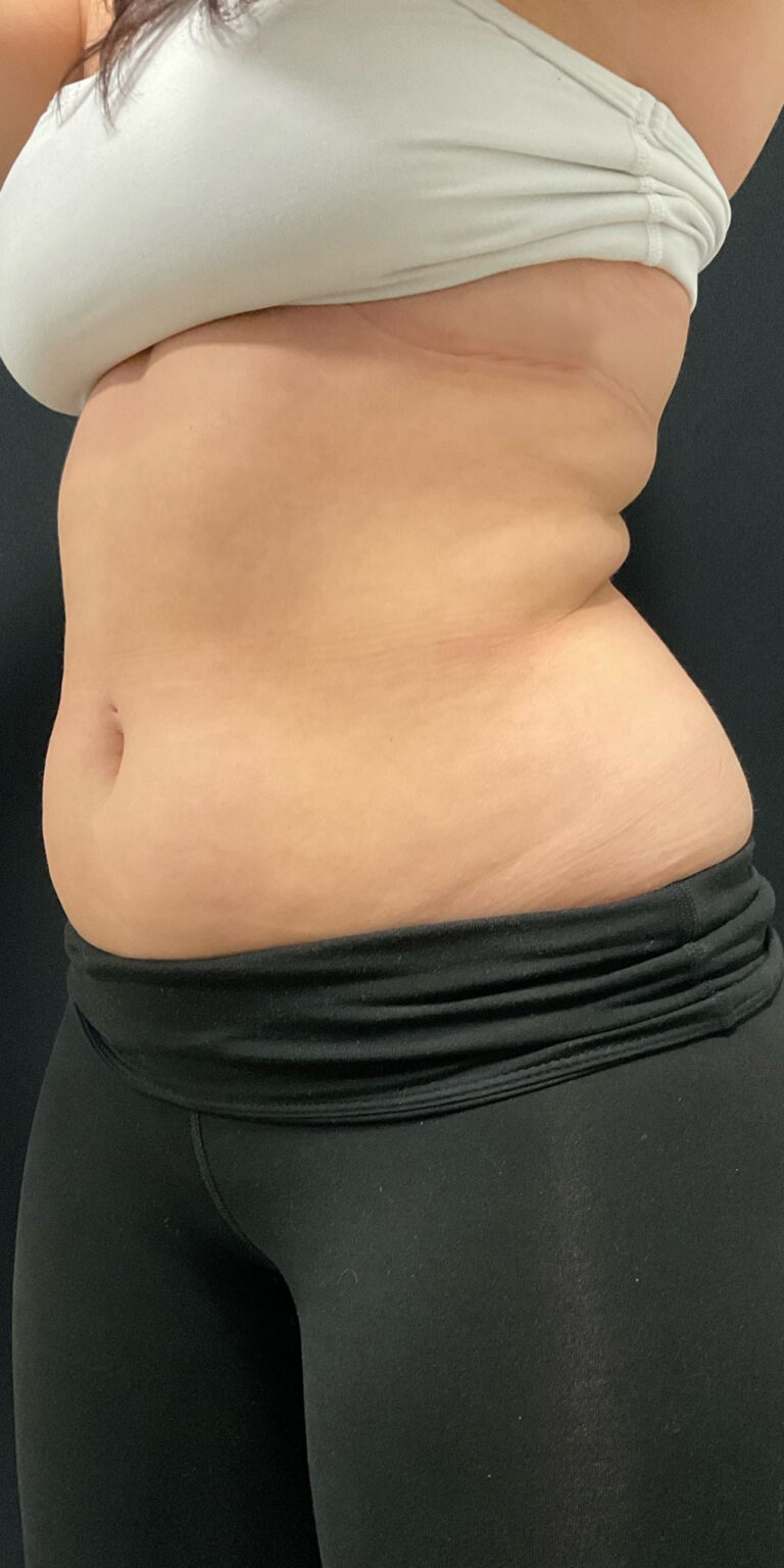 Before Image: CoolSculpting - left-front-oblique