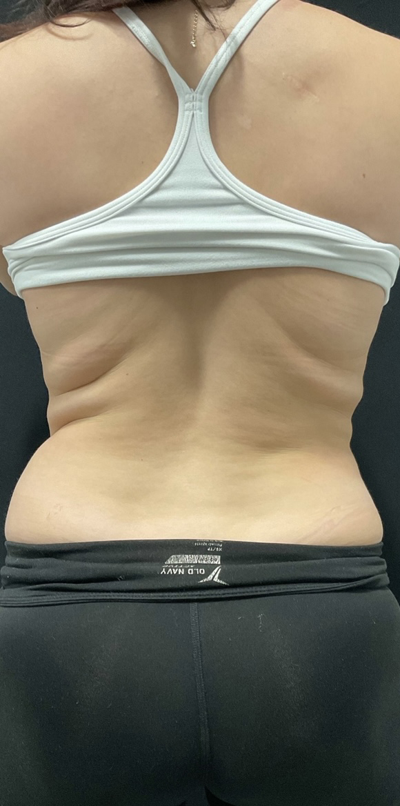 Before Image: CoolSculpting - back