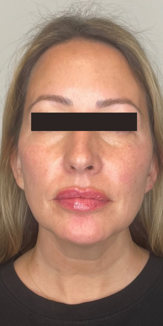 After Image: Lip & Cheek Filler - front