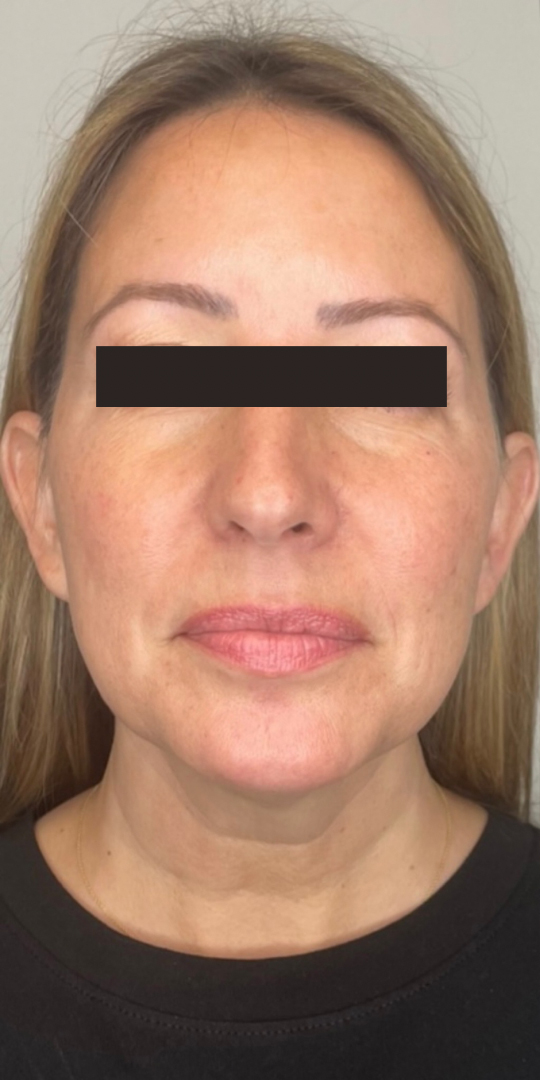 Before Image: Lip & Cheek Filler - front