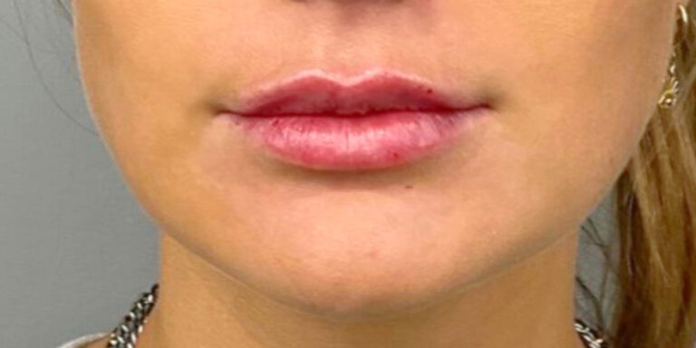 After Image: Lip Filler - front