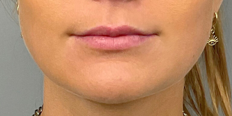 Before Image: Lip Filler - front